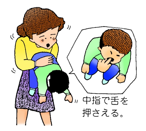 背部叩打法小児イラスト
